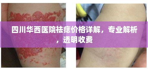 四川華西醫(yī)院祛痣價格詳解，專業(yè)解析，透明收費