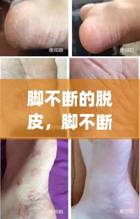 腳不斷的脫皮，腳不斷脫皮還癢 