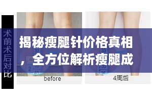 揭秘瘦腿針價(jià)格真相，全方位解析瘦腿成本！