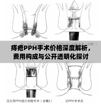 痔瘡PPH手術(shù)價(jià)格深度解析，費(fèi)用構(gòu)成與公開透明化探討