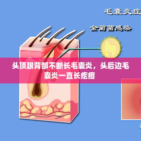頭頂跟背部不斷長毛囊炎，頭后邊毛囊炎一直長疙瘩 