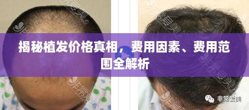 揭秘植發(fā)價(jià)格真相，費(fèi)用因素、費(fèi)用范圍全解析