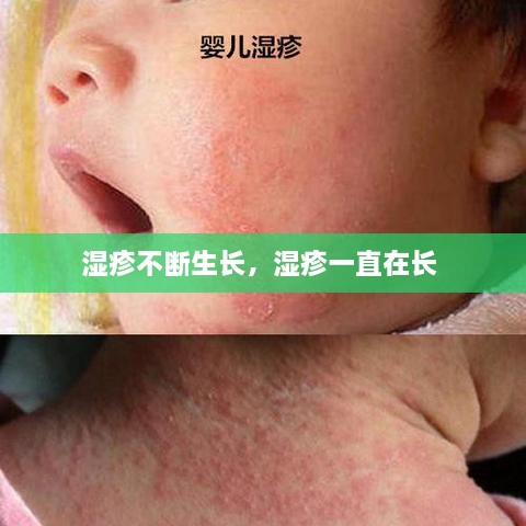 濕疹不斷生長，濕疹一直在長 