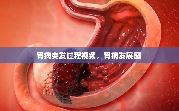 胃病突發(fā)過程視頻，胃病發(fā)展圖 