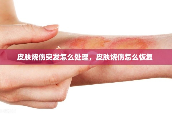 皮膚燒傷突發(fā)怎么處理，皮膚燒傷怎么恢復(fù) 